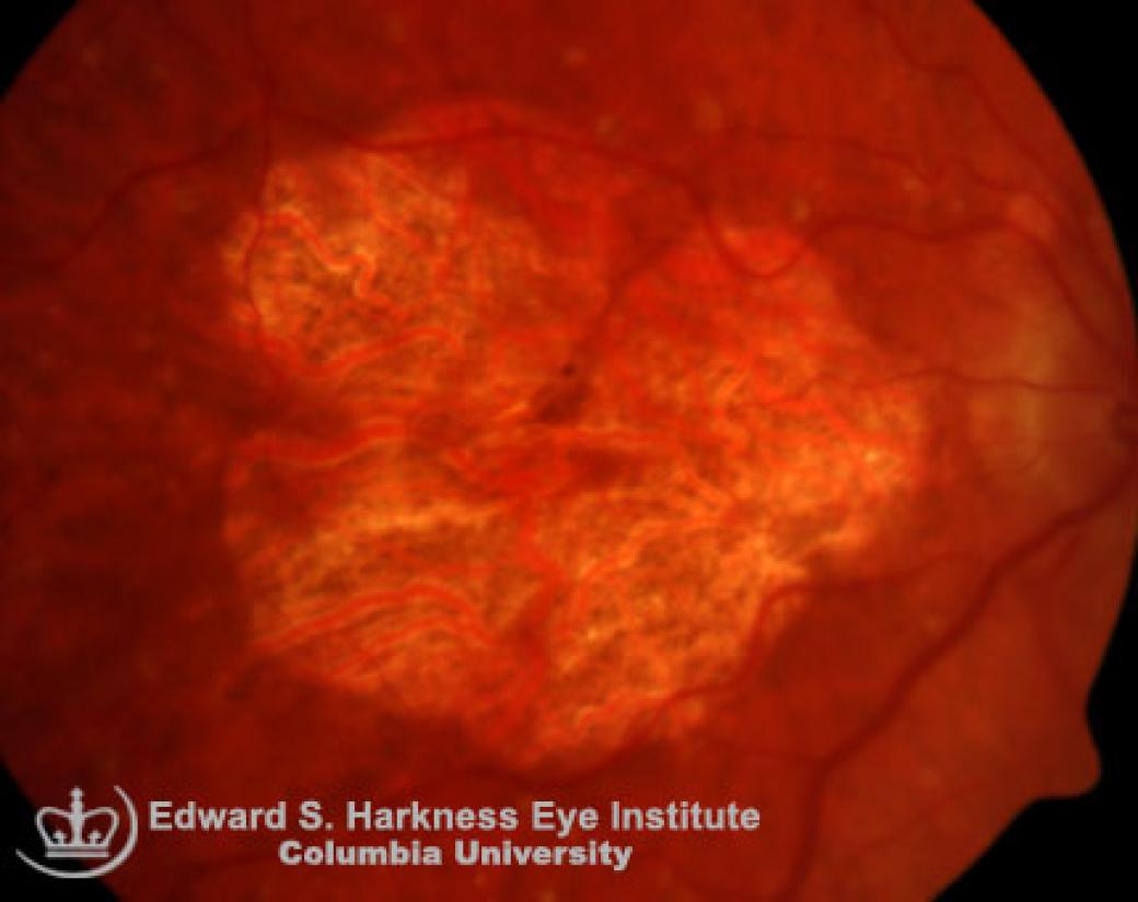 Geographic Atrophy Vagelos College of Physicians and Surgeons