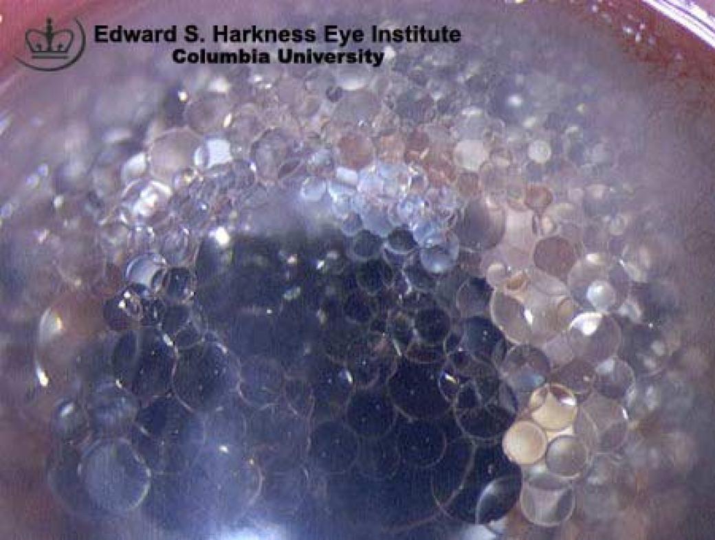 Silicone Oil in the Anterior Chamber Vagelos College of Physicians