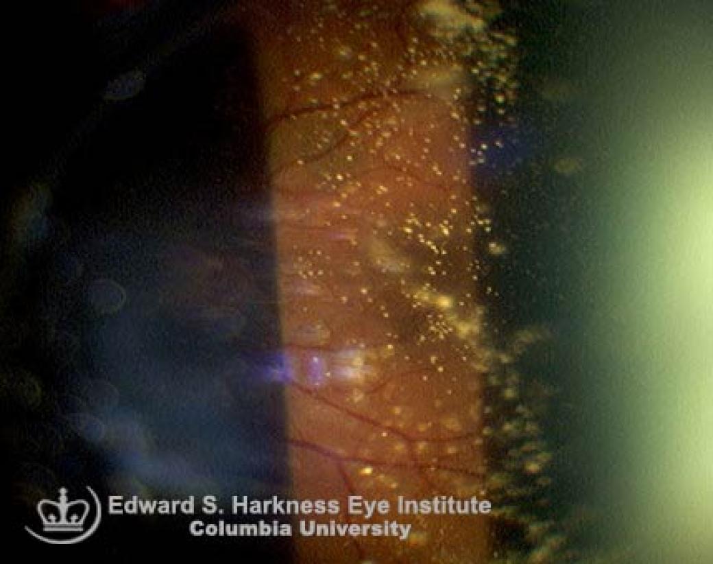 Asteroid Hyalosis Vagelos College of Physicians and Surgeons