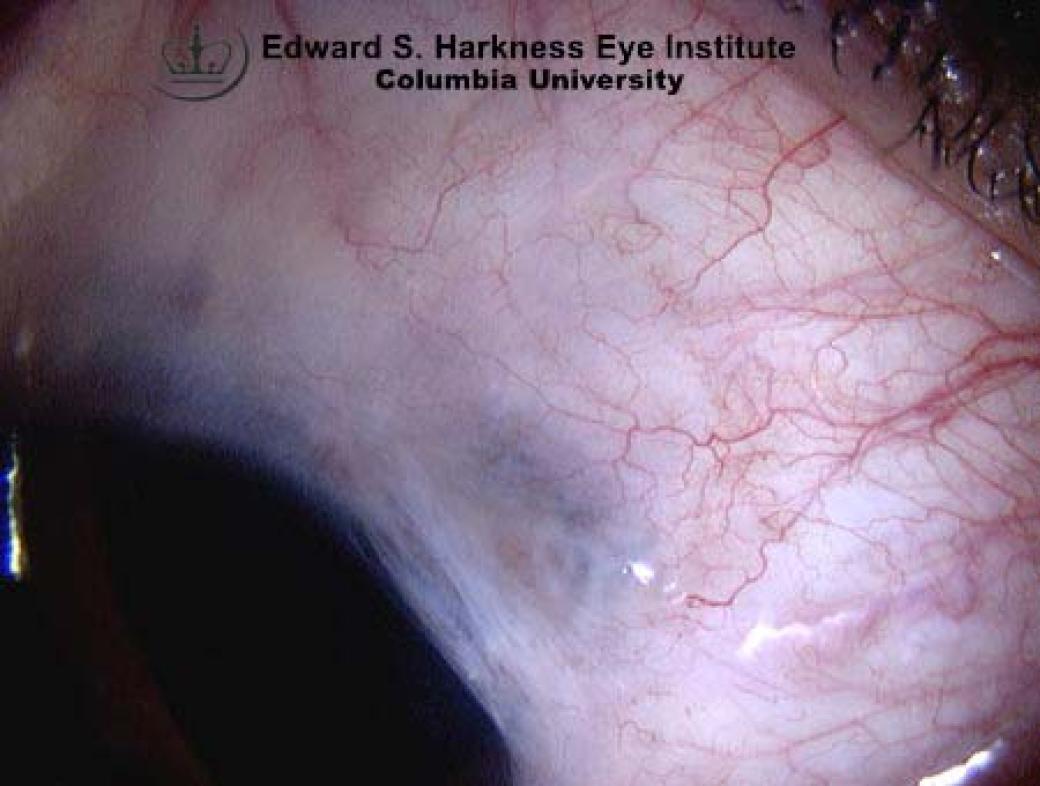 Filtering Bleb Failure Vagelos College of Physicians and Surgeons