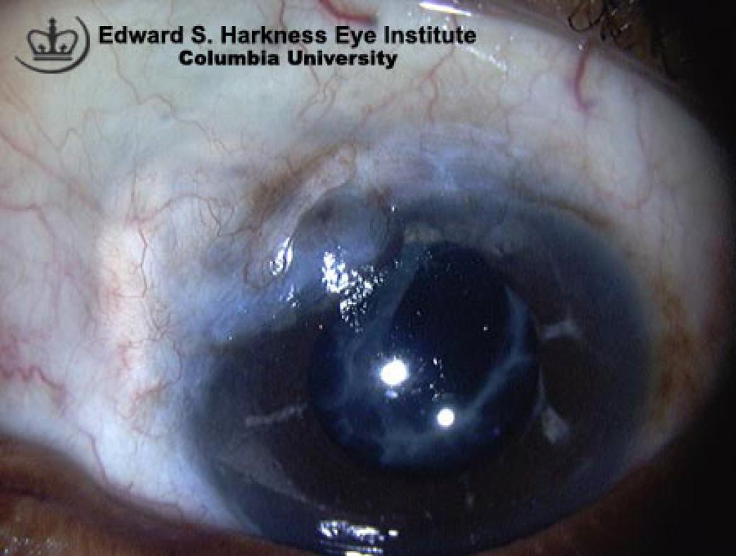 Filtering Bleb Failure Vagelos College of Physicians and Surgeons