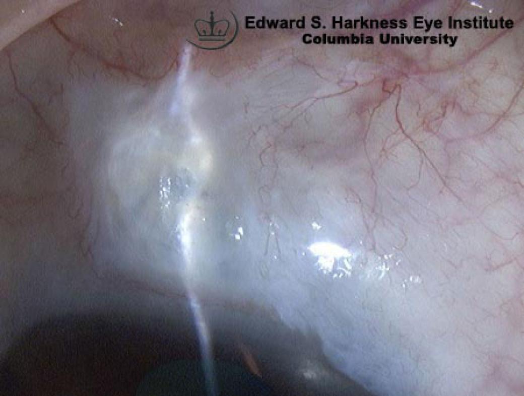 Functioning Filtering Bleb Vagelos College of Physicians and Surgeons