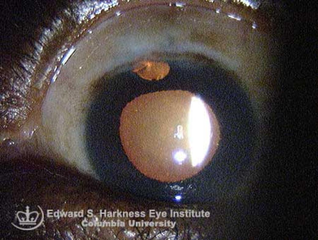 Peripheral Iridectomy Vagelos College of Physicians and Surgeons