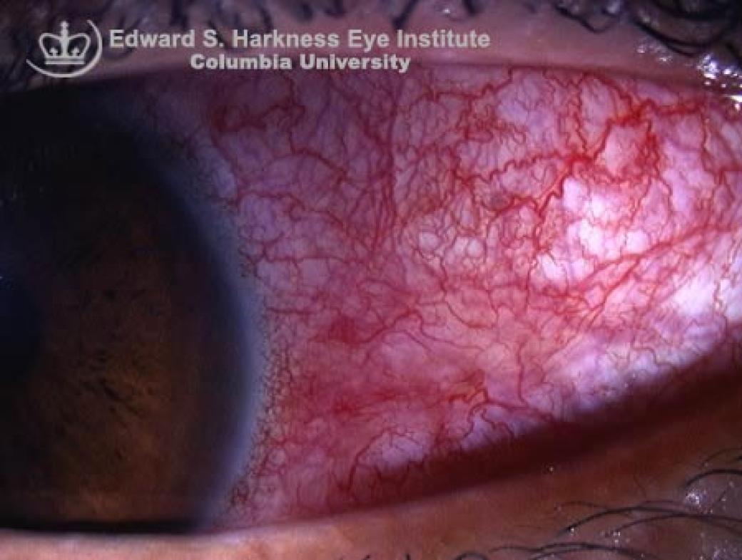 Diffuse Scleritis Vagelos College of Physicians and Surgeons