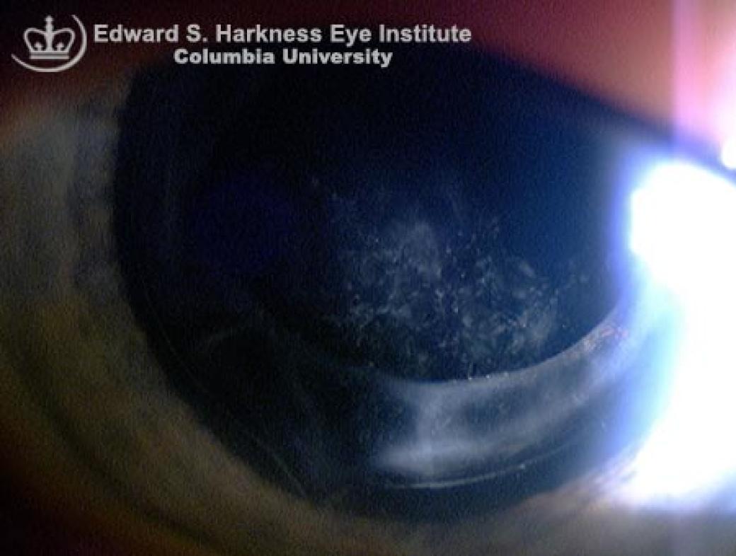 Posterior Capsule Opacification Vagelos College of Physicians and