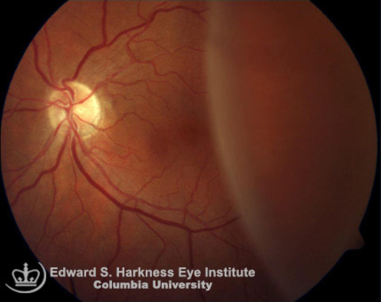 Degenerative Retinoschisis Vagelos College of Physicians and Surgeons