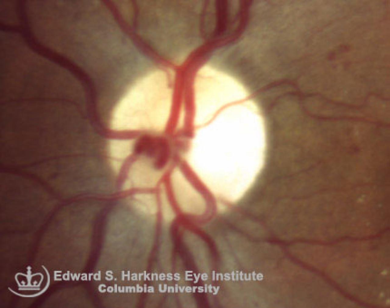 Prepapillary Vascular Loops Vagelos College of Physicians and Surgeons