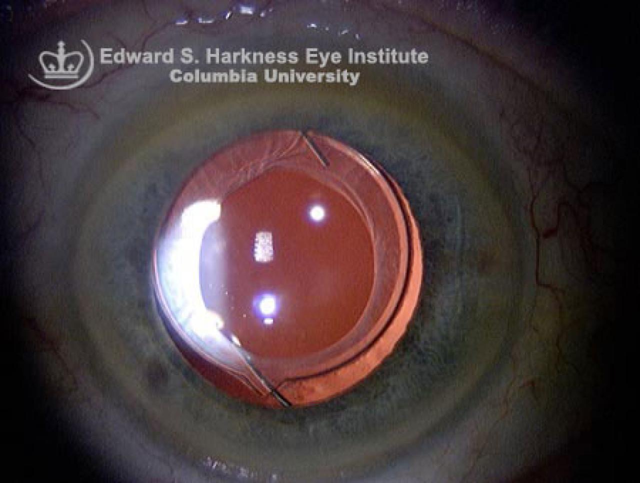 Pseudophakia Vagelos College of Physicians and Surgeons