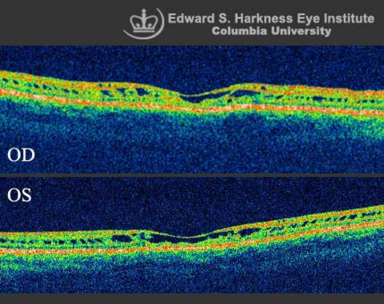 Xlinked Juvenile Retinoschisis (OCT Study) Vagelos College of