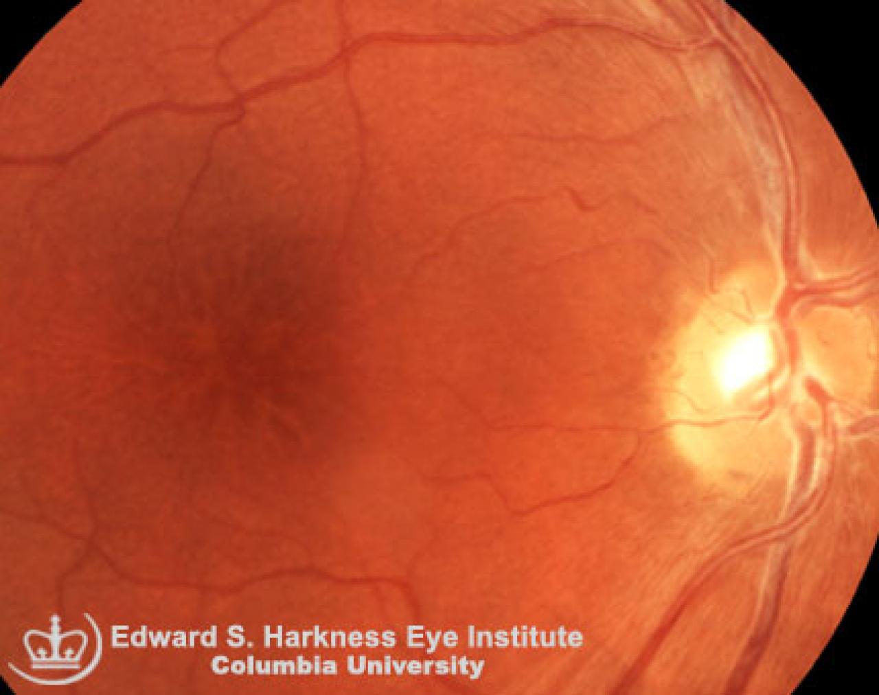 Xlinked Juvenile Retinoschisis Vagelos College of Physicians and