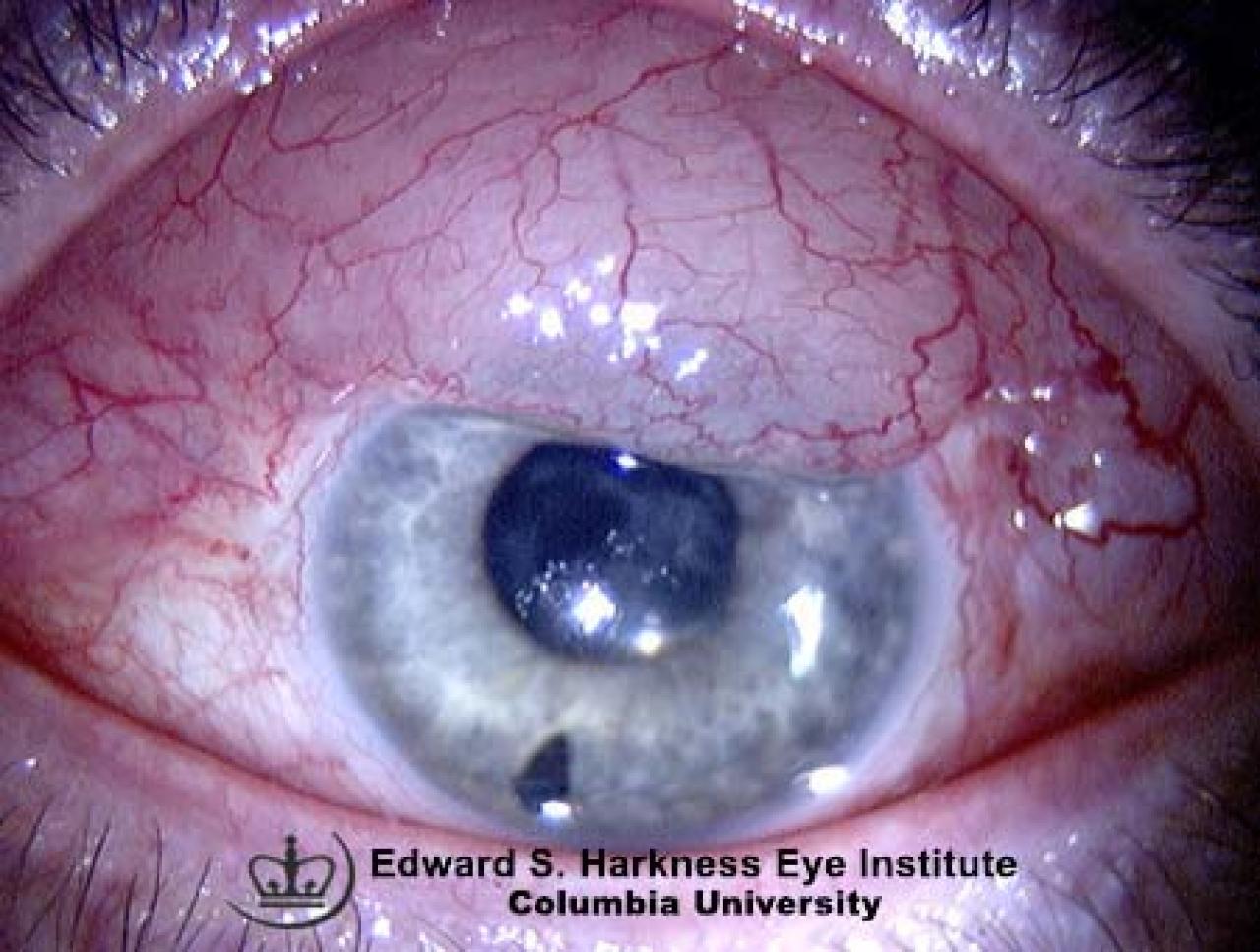 Overhanging Bleb Vagelos College of Physicians and Surgeons