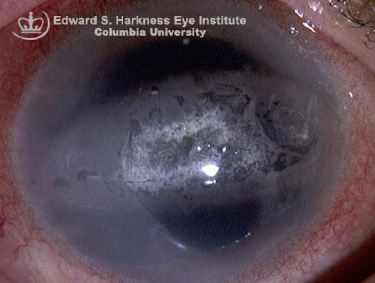 Band Keratopathy Vagelos College of Physicians and Surgeons