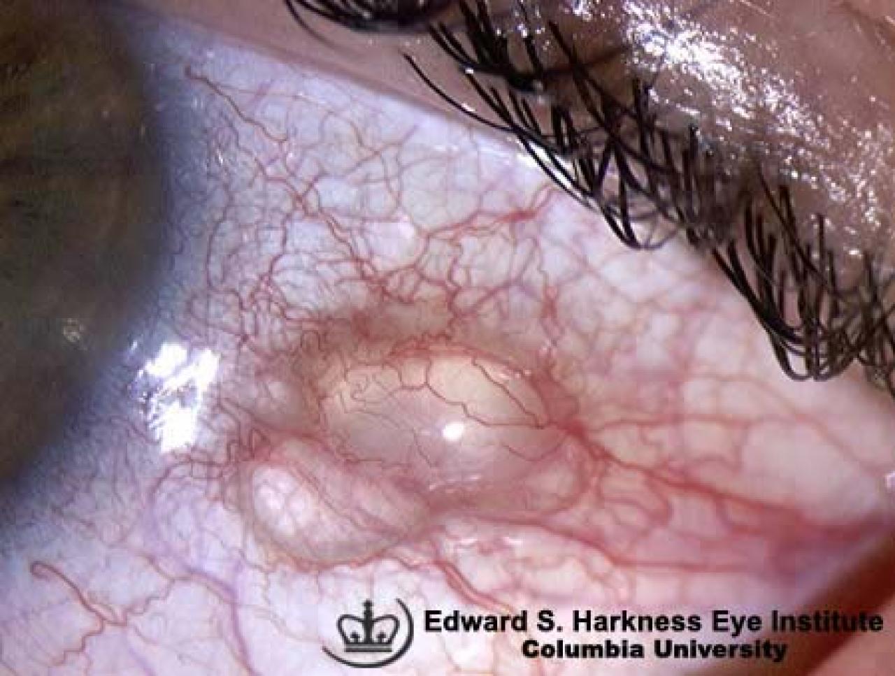 Conjunctival Cyst Vagelos College of Physicians and Surgeons