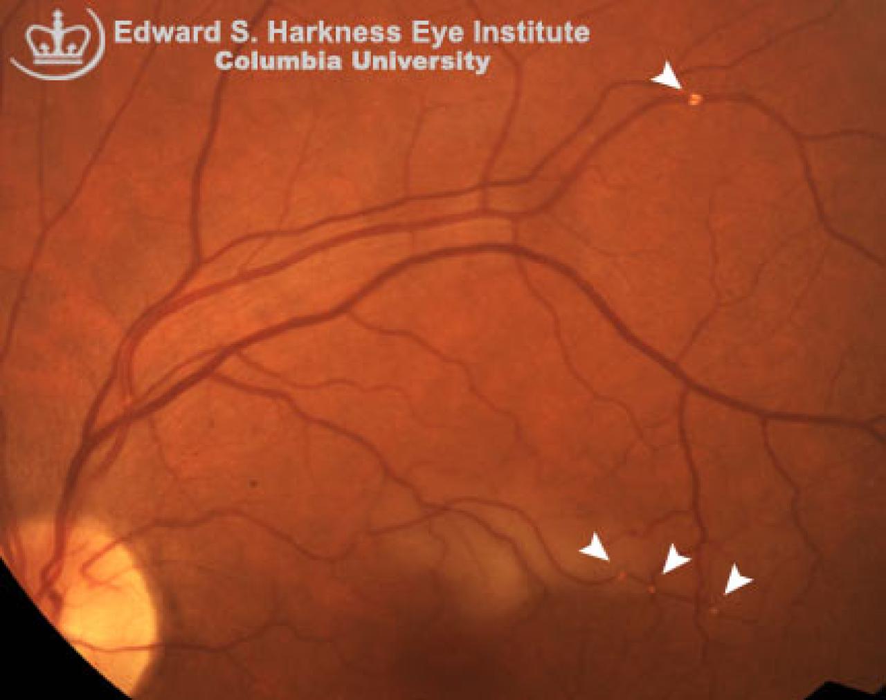 Hollenhorst Plaques Vagelos College of Physicians and Surgeons