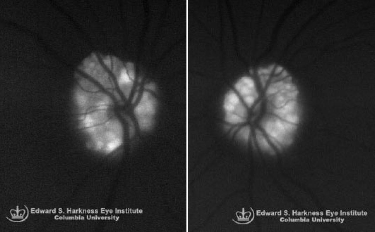 Optic Nerve Drusen Vagelos College of Physicians and Surgeons