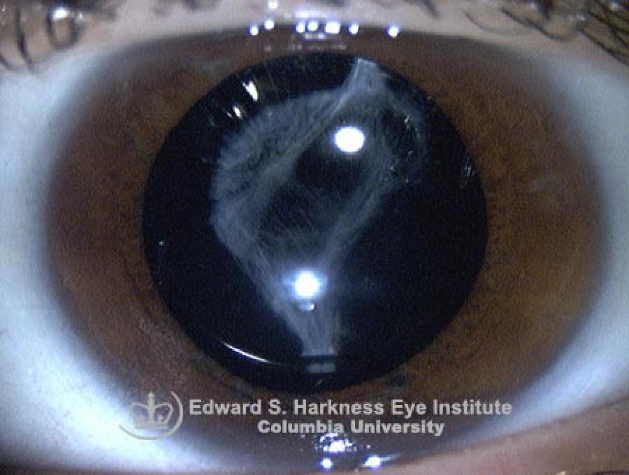 Posterior Capsule Opacification Vagelos College of Physicians and