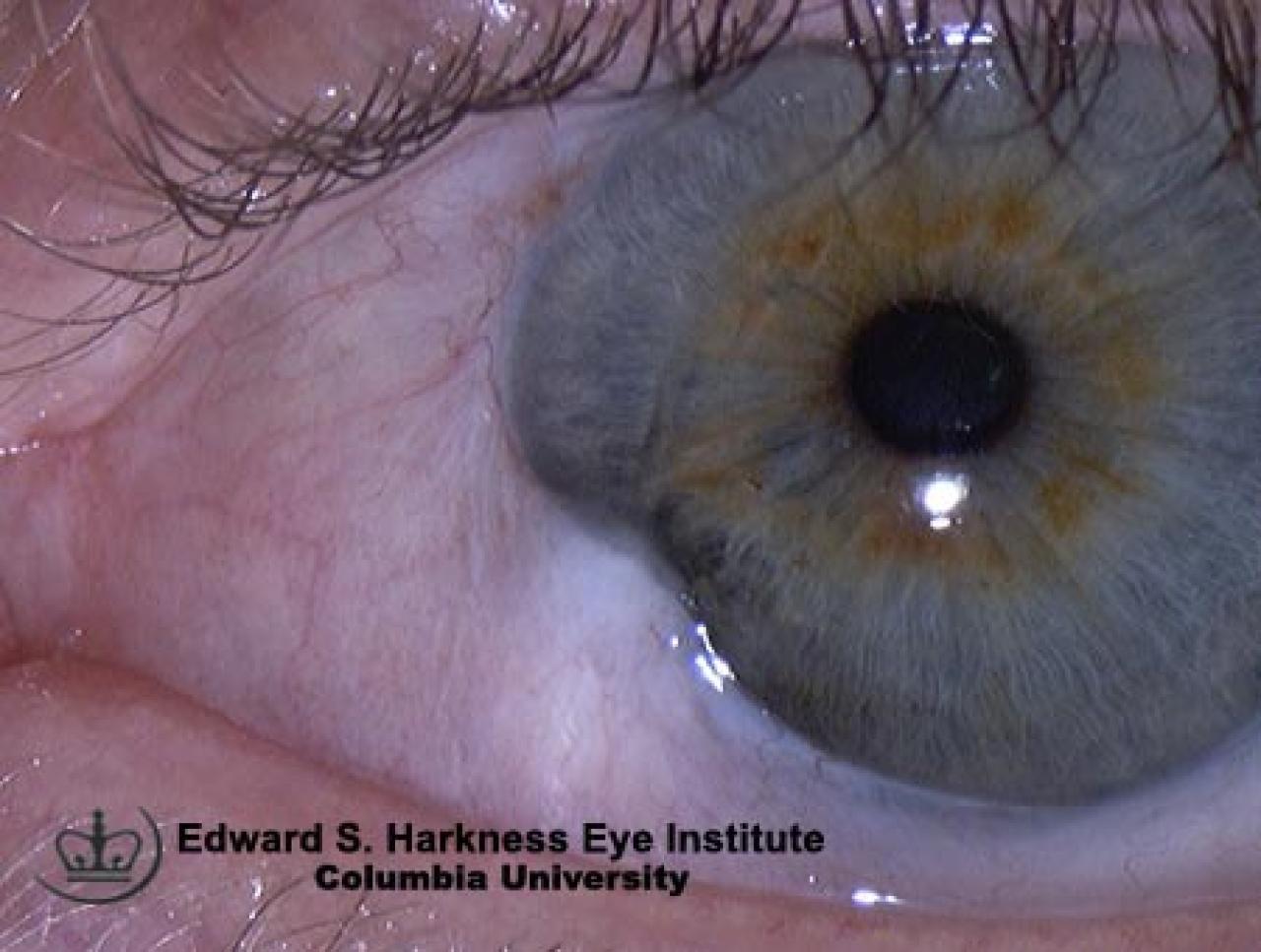 Pseudopterygium Vagelos College of Physicians and Surgeons