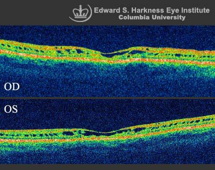 X-linked Juvenile Retinoschisis (OCT Study) | Vagelos College of ...