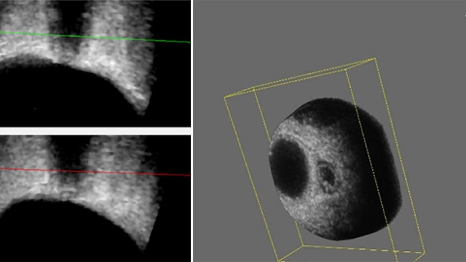 Sagittal and transverse sections thru the optic nerve (left) and coronal slice through the volume obtained by 3D ultrasound.