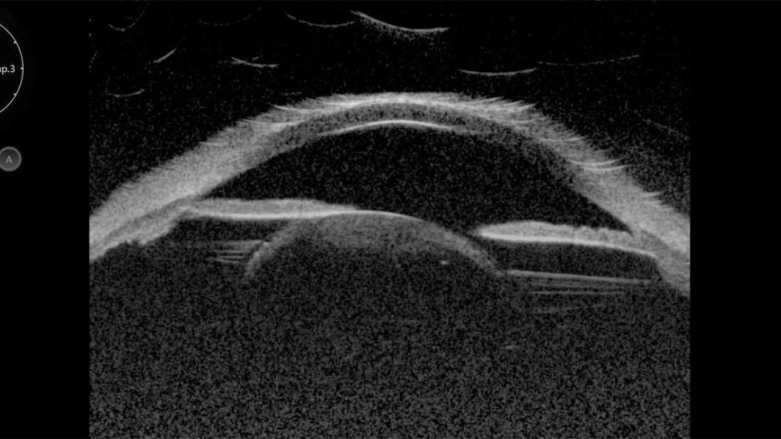 UBM image of subluxed lens in Marfan syndrome patient.