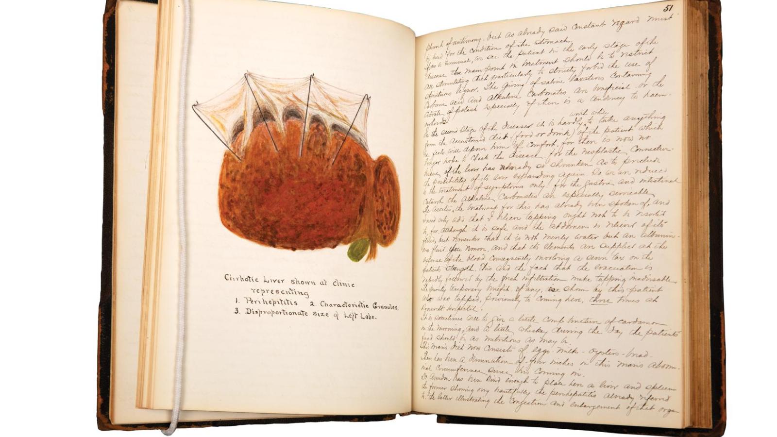 A student notebook featuring a colored illustration of a cirrhotic liver