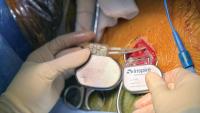 Two hands wearing surgical gloves holds the Inspire device next to an implantation site in a patient's neck