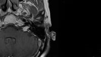 An MRI of a patient's head showing an otology related condition