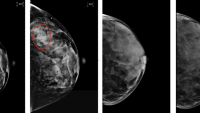 Four mammogram images