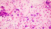 Stock image of a microscopic field of breast cancer