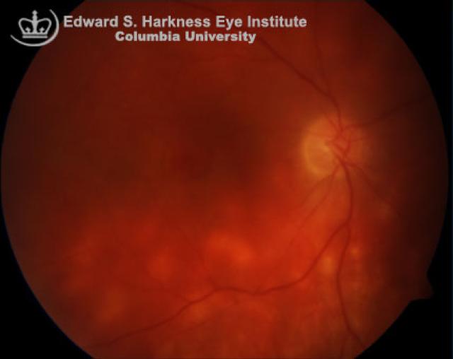 Birdshot Retinochoroidopathy Vagelos College of Physicians and Surgeons
