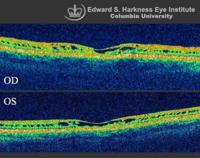 Xlinked Juvenile Retinoschisis (OCT Study) Vagelos College of