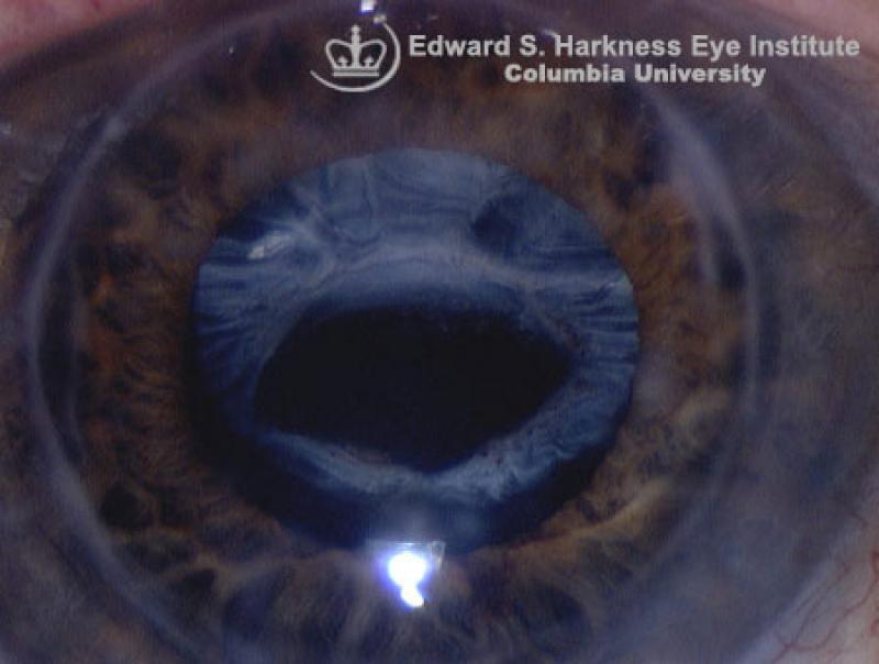 Anterior Capsulorhexis Contracture Vagelos College of Physicians and