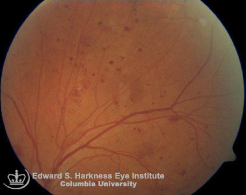 dot blot hemorrhages