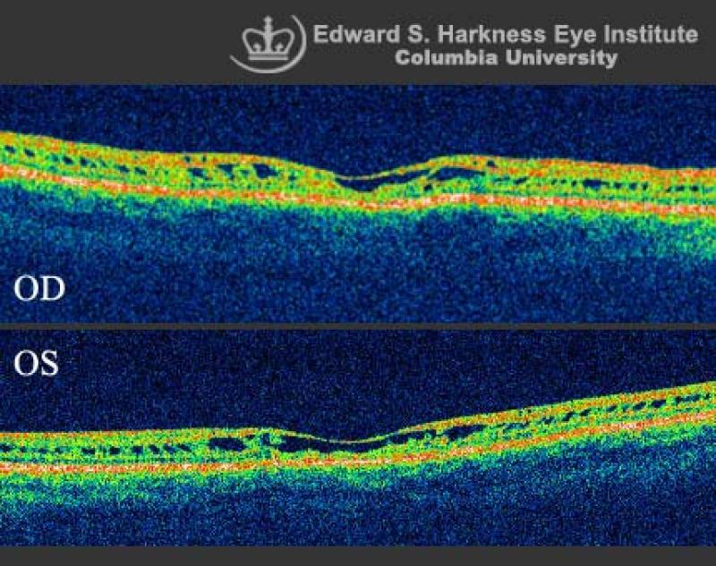 Xlinked Juvenile Retinoschisis (OCT Study) Vagelos College of
