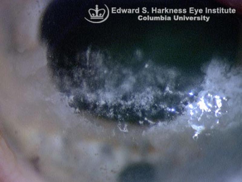 Band Keratopathy Vagelos College of Physicians and Surgeons