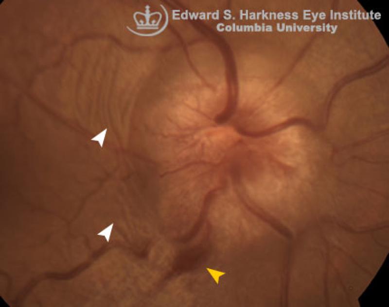 Pseudotumor Cerebri | Vagelos College of Physicians and Surgeons